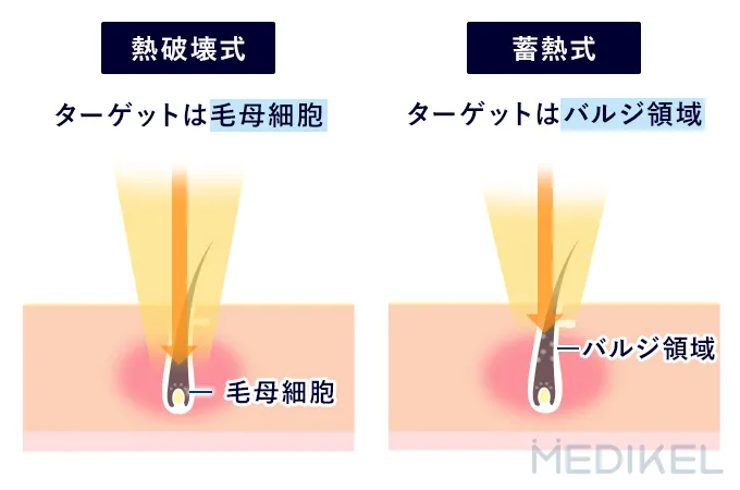 ヒゲの医療脱毛の二つの脱毛方式