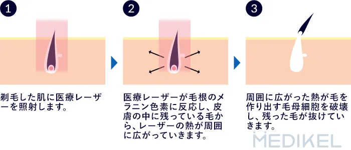 ヒゲ脱毛の仕組み