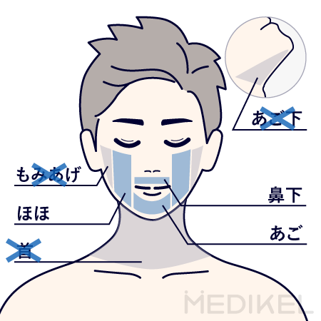 リアラクリニックのヒゲ脱毛の施術範囲