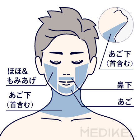 メンズリゼのヒゲ脱毛の施術範囲