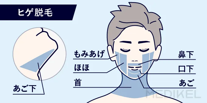 ヒゲ脱毛の施術に含まれる範囲